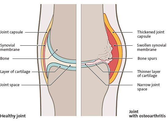 This simple anatomical illustration shows a healthy joint (left) and a joint with osteoarthritis-related changes (right).