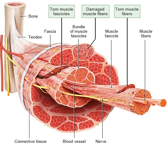 Illustration: Various degrees of muscle strain