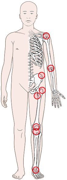 This illustration uses a schematic representation of the human body to show the parts of the body where inflamed bursae commonly occur.