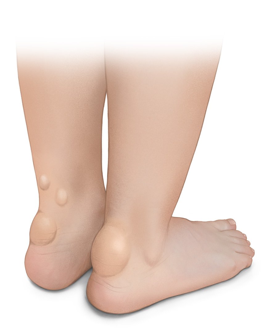 Photorealistic image showing cholesterol deposits around the Achilles tendons.