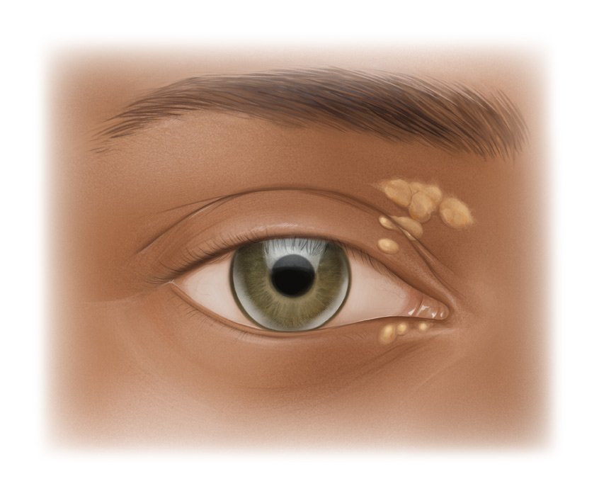 Photorealistic image showing cholesterol deposits around the eyelid and in the iris.