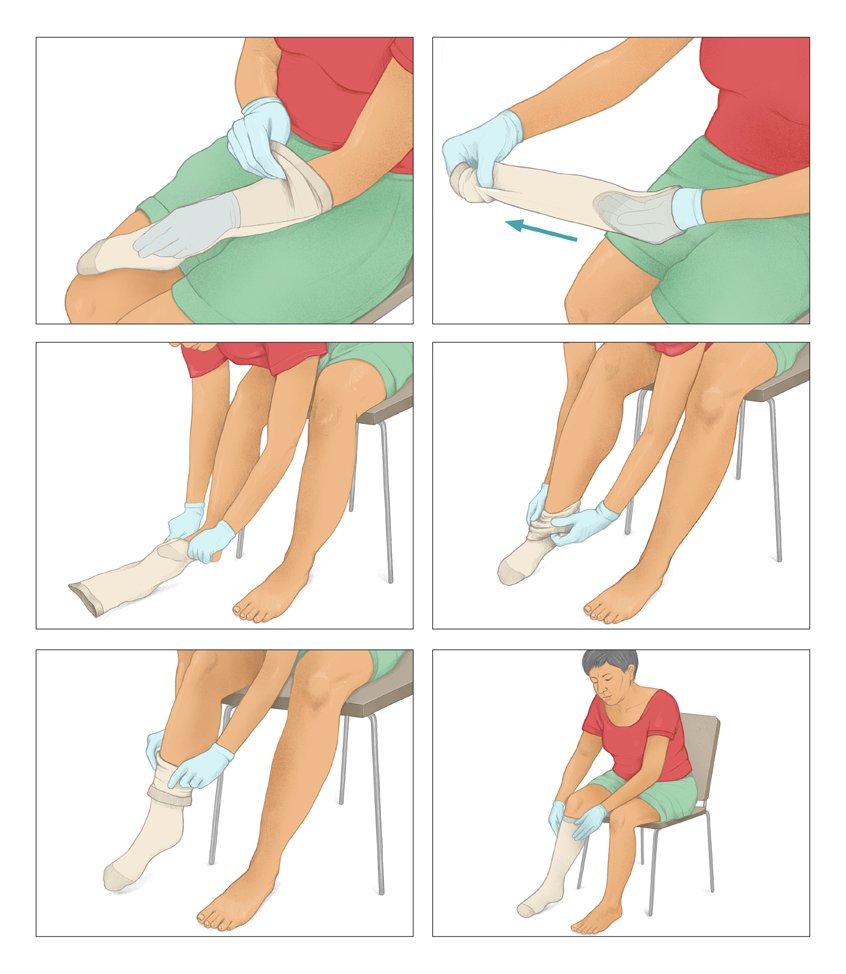 This multi-panel photorealistic illustration shows, how to put on a compression stocking correctly in six steps.