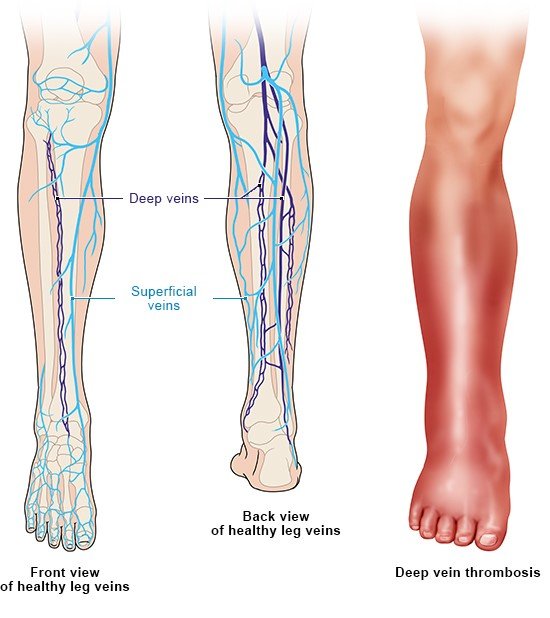 This illustration shows a healthy leg with superficial and deep veins and a reddened lower leg with deep vein thrombosis.