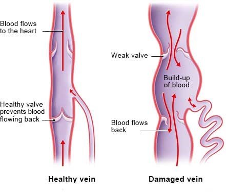 This simplified anatomical illustration shows Back flow in a healthy vein (left) and in a damaged vein.