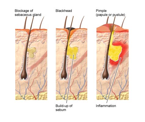 This illustration shows the keratinization of a sebaceous gland (left), the accumulation of sebum in a blackhead (middle), and an inflamed pimple (right).