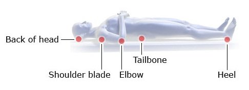 This illustration shows the places where pressure ulcers commonly develop in people lying down.