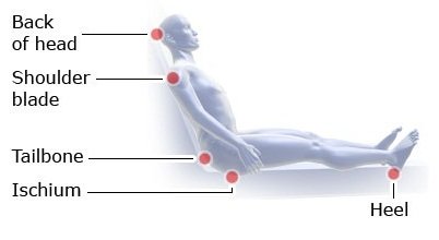 This illustration shows the places where pressure ulcers commonly develop in people sitting.