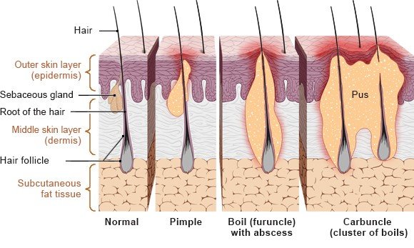 This simplified anatomical illustration shows possible hair follicle infections
