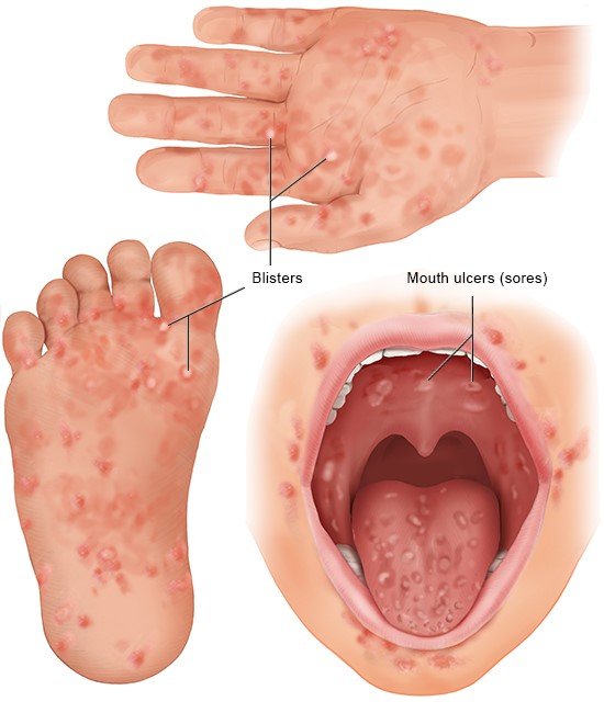 This photorealistic illustration shows the typical rash on the hands, feet and mouth.