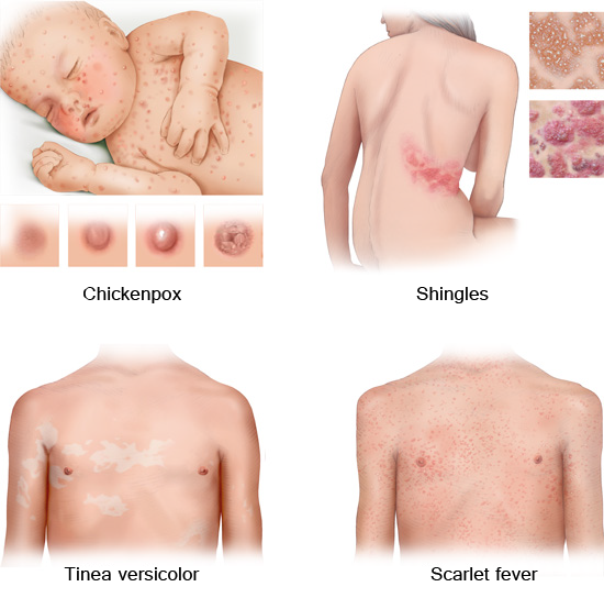 Typical skin changes due to common infectious diseases