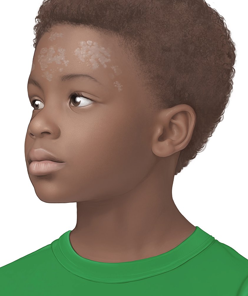 This photorealistic illustration shows the face of a boy with tinea versicolor. It shows light-colored patches on dark skin on his forehead.