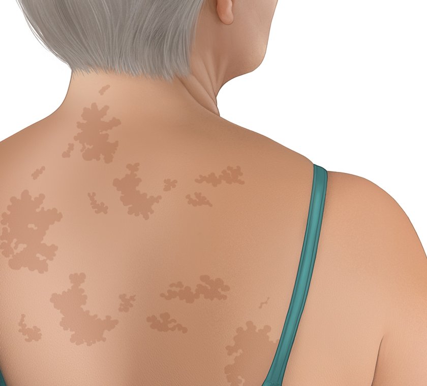 This photorealistic illustration shows the back of a woman with tinea versicolor. She has dark-colored patches on light skin.
