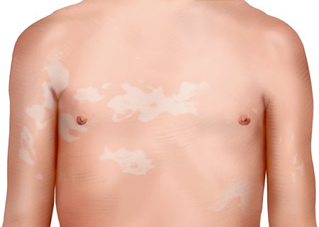 This photorealistic illustration shows the chest of a boy with tinea versicolor. He has light-colored patches on light skin.