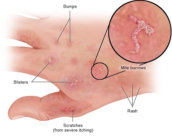 This illustration shows a typical scabies rash. Bumps, blisters and wounds are shown in detail, as well as mite burrows.