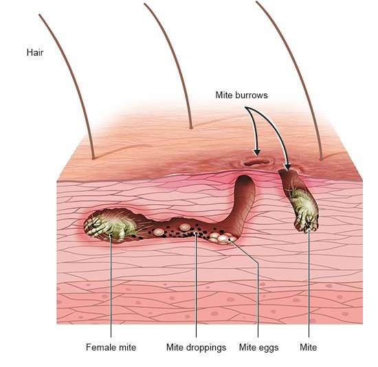 This illustration shows scabies mites in their system of burrows under the skin – with eggs and droppings.