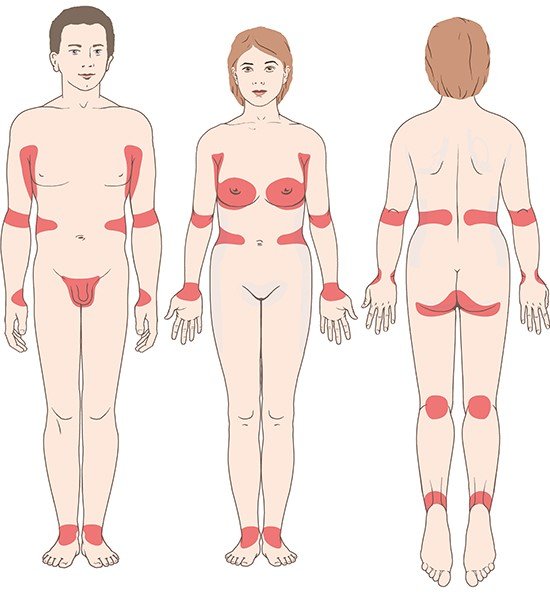 This illustration shows the areas of skin that can be infested by scabies mites in men and women.