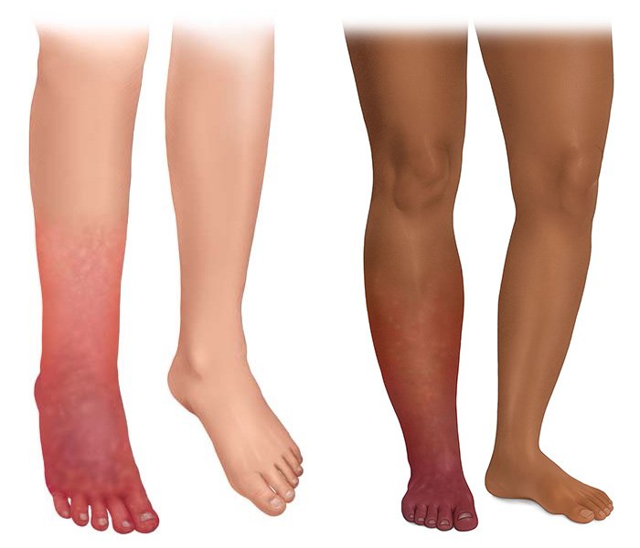 This photorealistic illustration shows a lower leg with cellulitis (left). The infection has reached deeper layers of skin and tissue.