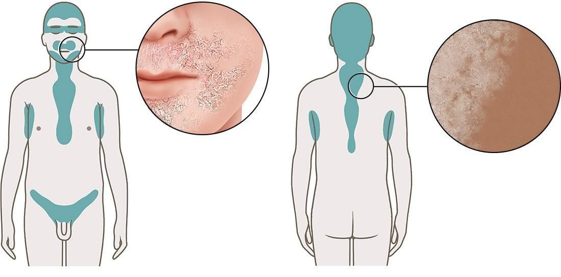 Illustration: Seborrheic dermatitis: Typical areas and appearance on light and dark skin 