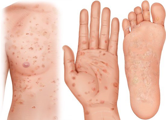 Illustration: Possible syphilis rashes