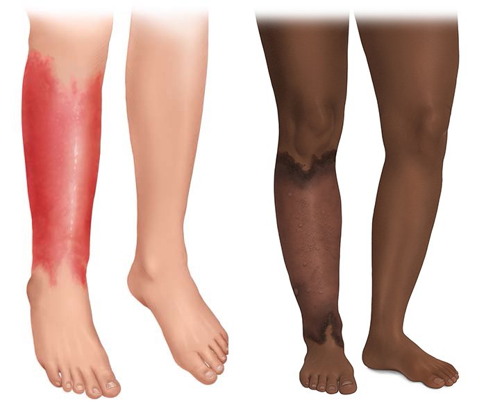 This photorealistic illustration shows a lower leg with erysipelas (left). The outer layers of skin are red and inflamed.