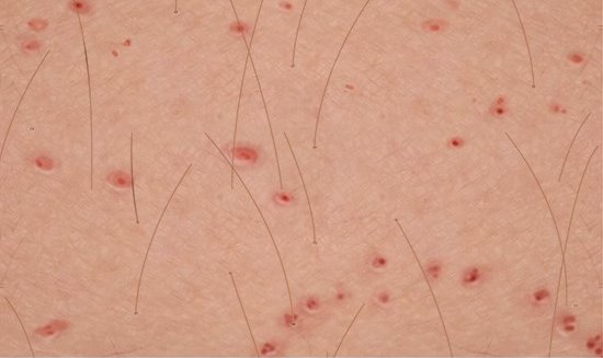 This illustration shows bedbug bites on the skin. Bedbugs often leave small red, slightly swollen spots that itch.