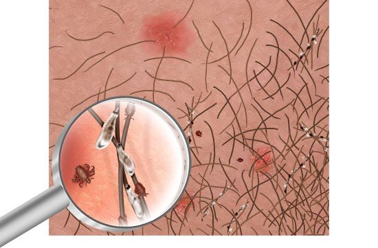 This illustration shows bluish-grey and red pubic louse bites on the skin and a detailed view of a pubic louse and eggs stuck to hair.
