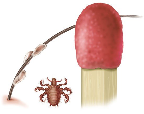 This illustration shows a pubic louse and an egg (nit) next to the head of a match.