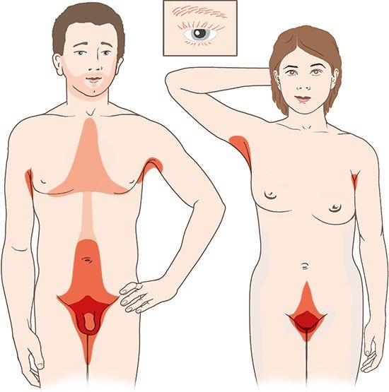 This illustration shows typical areas where pubic lice live on the body in men and women.