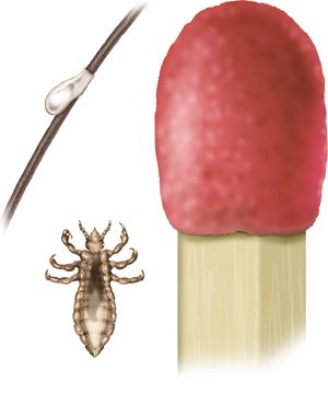 This illustration shows a nit and an adult head louse on the left. The adult louse is smaller than the match head shown on the right.