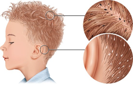 This illustration shows head lice on a boy's head and nits behind his ears: His head can be seen on the left, with close-up details on the right.