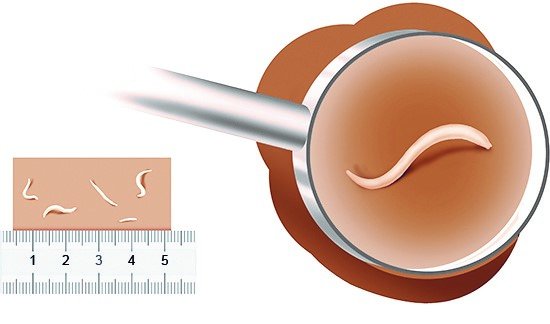 This simplified illustration shows pinworms in their real size (left) and enlarged with a magnifying glass (right).