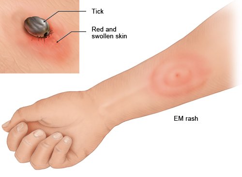 This photorealistic illustration shows the typical symptom of Lyme disease following a tick bite on the forearm – a rash called erythema migrans.