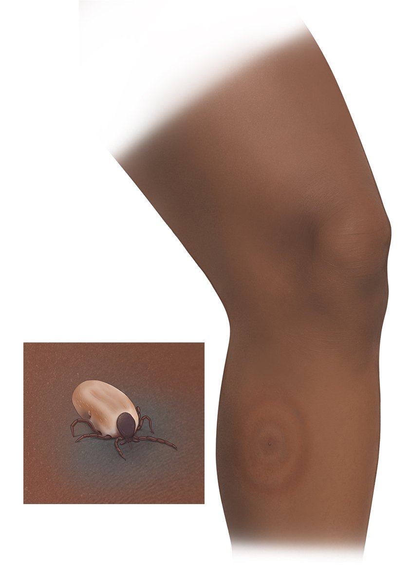 This photorealistic illustration shows how the skin changes after a tick bite, and an EM rash on dark skin (lower leg).