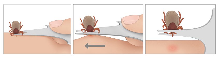 This illustration shows how to remove a tick in three steps using a tick-removal card.