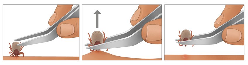 This illustration shows how to remove a tick in three steps using tick tweezers.