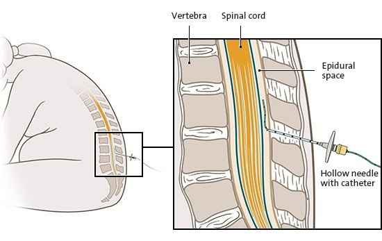 This simplified anatomical illustration shows how and where an epidural anesthetic is given (detailed view on the right).