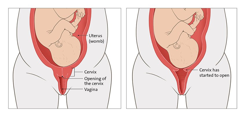 Closed cervix (left) and cervix that has started to open (right)