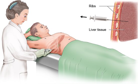 Illustration: Performing a biopsy – as described in the article