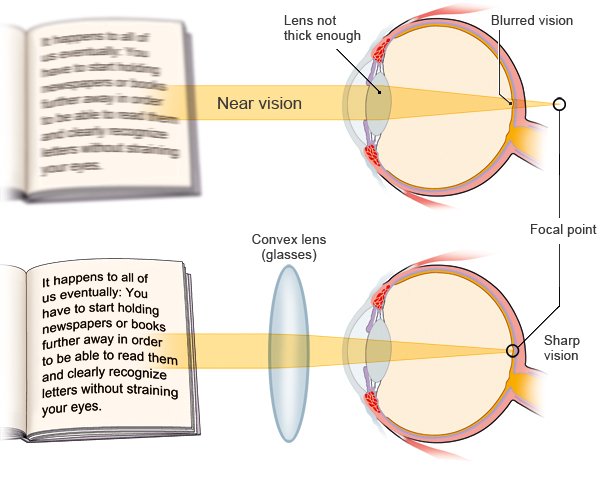 Illustration: Correcting presbyopia