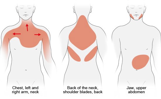 Illustration: Possible areas of pain during a heart attack – as described in the information