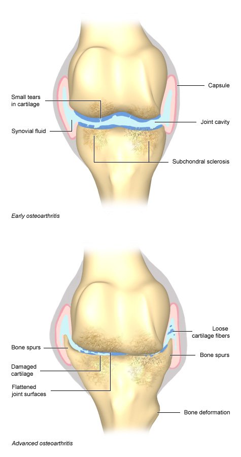 Illustration: Early and advanced osteoarthritis - as described in the article