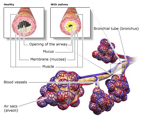 Illustration: Structure of the airways in the lungs: healthy bronchi and bronchi narrowed by asthma – as described in the article