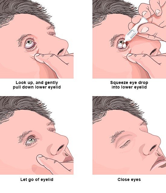 Tips for applying eye drops