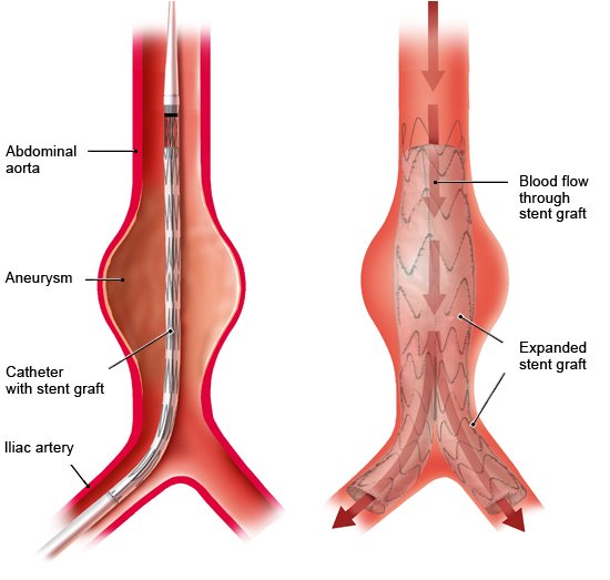 Illustration: Endovascular surgery with stent graft
