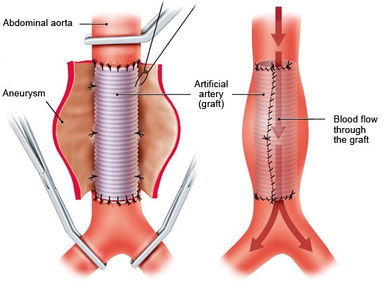 Illustration: Open surgery: The aneurysm is replaced with an artificial vessel (graft)