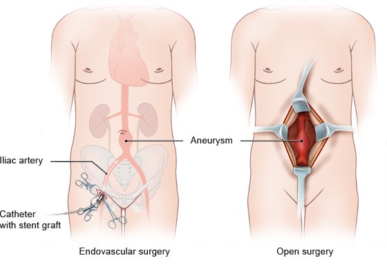 Illustration: Surgical techniques for abdominal aortic aneurysm