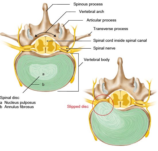 Illustration: Healthy and slipped disc (cross-sectional view of the lumbar spine – from above)