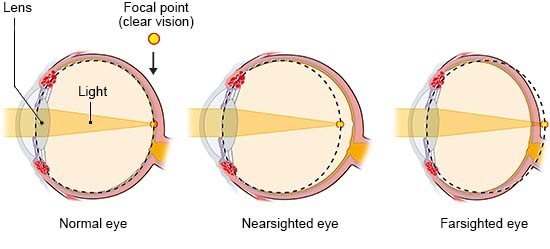 Illustration: Refractive errors in nearsightedness and farsightedness