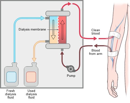 Illustration: In hemodialysis, the blood is cleaned outside the body – as described in the article