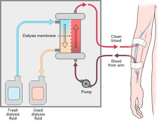 How Does Dialysis Work Informedhealth how-does-dialysis-work-informedhealth